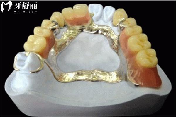 為什么不鼓勵(lì)年輕人用活動(dòng)假牙呢?了解戴活動(dòng)假牙的好處和壞處后便知道啦