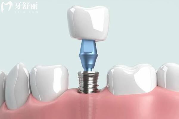 ?？谥Z貝爾口腔醫(yī)院收費(fèi)標(biāo)準(zhǔn)公布(種植牙