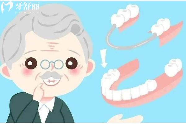 活動義齒的種類和材料有哪些？種類與材料的口腔修復新手指南