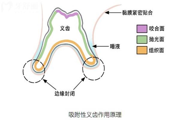 吸附式假牙的優(yōu)點(diǎn)和缺點(diǎn)是什么?究竟值不值得選?帶你解析詳細(xì)優(yōu)缺點(diǎn)與選擇指南