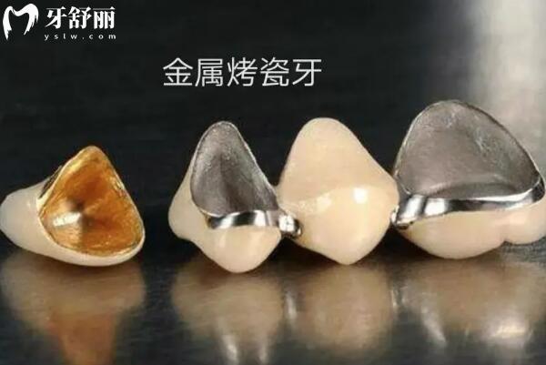 湖州金鉑利口腔收費(fèi)怎么樣?2025價格表更新:4店同價,種植牙1280元起