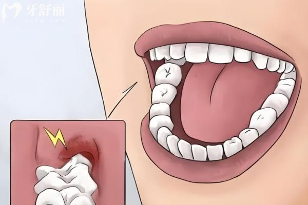 成都拔牙多少錢一顆