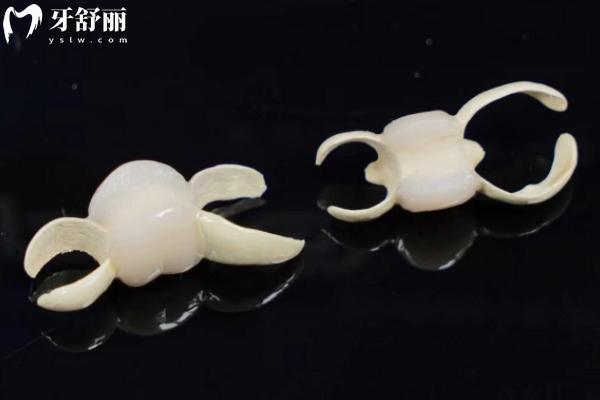 粘接橋修復(fù)優(yōu)缺點(diǎn)有哪些