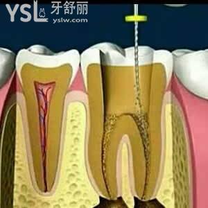 做根管治療到底疼不疼，我從來還沒有做過！