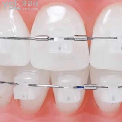 進(jìn)口陶瓷自鎖托槽