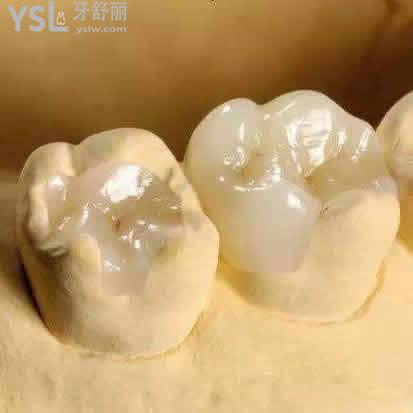 廈門登特口腔義獲嘉E.max press鑄瓷嵌體多少錢？