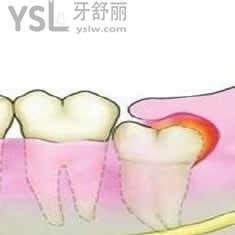 廈門登特口腔拔智齒多少錢？