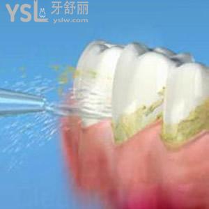 廈門登特口腔超聲波洗牙多少錢？