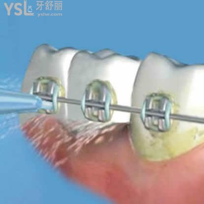普通噴砂潔牙