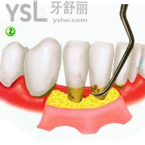 后牙齦下刮治