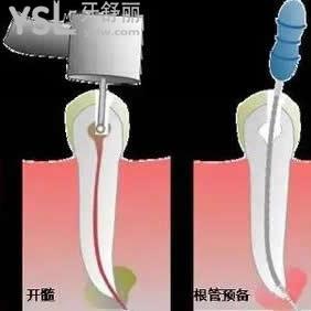 顯微根管治療