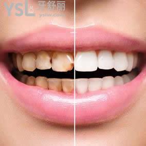 齦上潔治