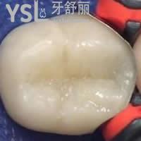 天津愛齒口腔樹脂補(bǔ)牙雙11優(yōu)惠價(jià)格