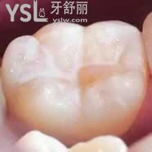 兒童窩溝封閉