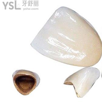 北京維樂口腔鈷鉻合金烤瓷牙價(jià)格貴嗎？