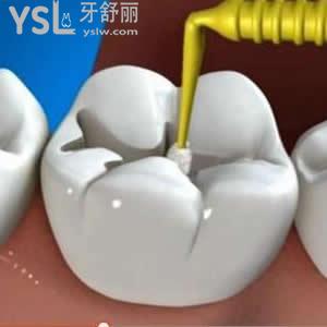 北京維樂口腔成人3m樹脂補(bǔ)牙價(jià)格