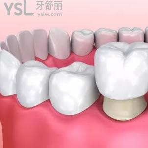 深圳正夫口腔鈷鉻合金烤瓷牙價格表