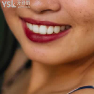昆明長(zhǎng)鵬口腔威蘭德全瓷牙價(jià)格表及優(yōu)點(diǎn)