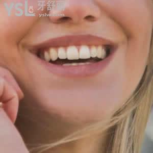 昆明長鵬口腔美國3MZ350XT樹脂填充補(bǔ)牙價(jià)格是多少？