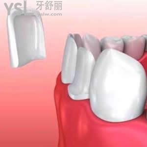 玻璃陶瓷貼面