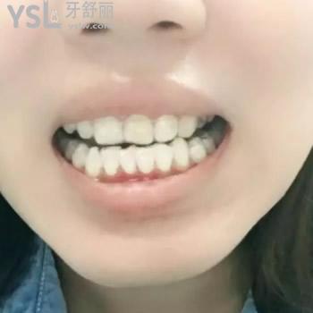 包頭植諾口腔亂收費(fèi)嗎？看看包頭植諾口腔進(jìn)口隱適美正畸價(jià)格后再定奪