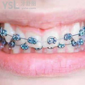 西安中諾口腔醫(yī)院金屬牙齒矯正價目表