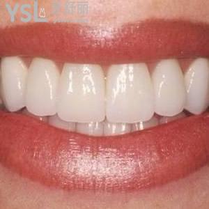 西安中諾口腔醫(yī)院瑞士e-max牙齒貼面價(jià)格貴嗎