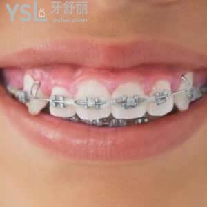 鄭州唯美口腔傳統(tǒng)金屬托槽牙齒矯正價格表