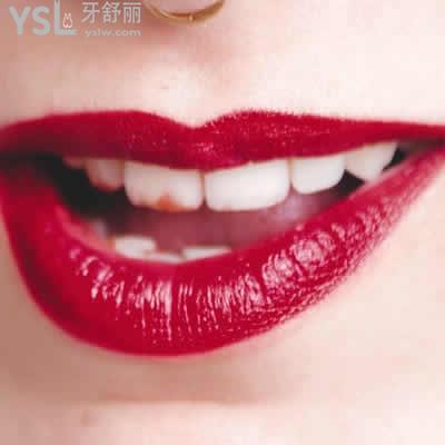 整牙必看深圳雅適美口腔美加超薄瓷貼面價格表