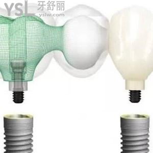 諾貝爾active種植體