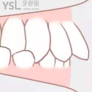 骨性開頜正畸
