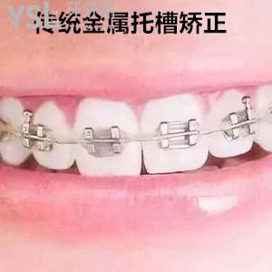 南京雅康口腔醫(yī)院正規(guī)嗎？南京雅康口腔金屬托槽矯正收費(fèi)標(biāo)準(zhǔn)