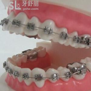 重慶口碑比較好的齊美口腔傳統(tǒng)金屬牙齒矯正價格活動來嘍！