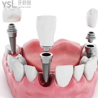 深圳質(zhì)美口腔韓國(guó)登騰種植體包干價(jià)貴不？