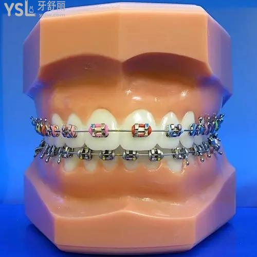 蘭州皓亞口腔牙齒矯正（傳統(tǒng)托槽）多少錢？