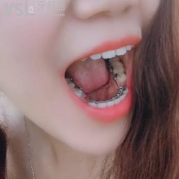 蘭州皓亞口腔個(gè)性化舌側(cè)矯正收費(fèi)標(biāo)準(zhǔn)