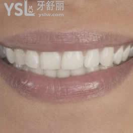 天包地牙齒矯正