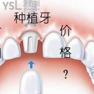 天津美奧口腔貴嗎？可以參考下進(jìn)口種植牙收費(fèi)如何。