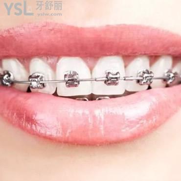 美國Damon自鎖托槽矯正