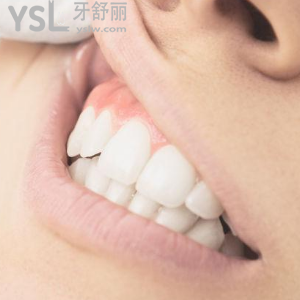 成都圣貝牙科醫(yī)院價(jià)格表之時(shí)代天使隱形矯正優(yōu)惠來(lái)嘍！