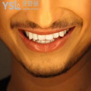 上海永華口腔門(mén)診部收費(fèi)標(biāo)準(zhǔn)隱適美隱形矯正多少錢(qián)？