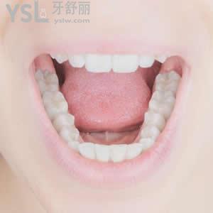 北京圣貝口腔樹脂補(bǔ)牙價(jià)格貴不貴