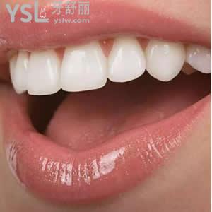 保定合眾口腔價(jià)格表之種植牙一顆多少錢？