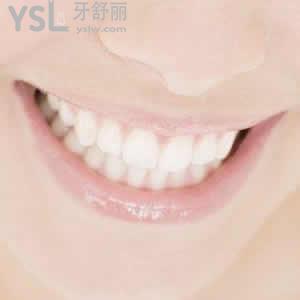 深圳富華醫(yī)院口腔科收費標(biāo)準(zhǔn)之鈷鉻合金烤瓷冠多少錢？
