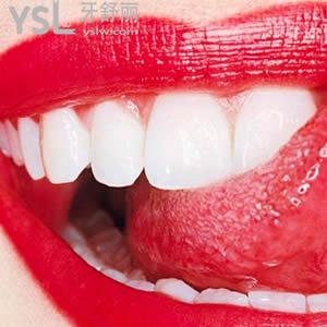 深圳富華醫(yī)院口腔科瓷貼面（E-MAX）多少錢？