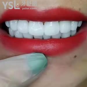 重慶成佳牙博士口腔醫(yī)院價(jià)格之全瓷貼面多少錢(qián)？