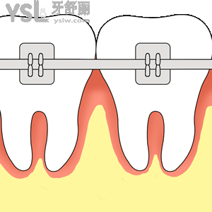 鄭州拜博口腔醫(yī)院牙齒矯正美國ORMCO（金屬）活動收費標(biāo)準(zhǔn)