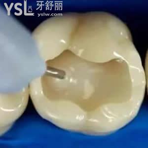 珠海九龍口腔醫(yī)院價格貴嗎？進(jìn)口3M納米樹脂補(bǔ)牙價格優(yōu)惠。