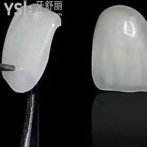 珠海九龍口腔醫(yī)院價(jià)目表，牙齒貼片樹脂貼面優(yōu)惠活動(dòng)