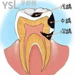 鄭州拜博口腔醫(yī)院價格貴嗎？美國3M納米樹脂補牙活動價可一點都不貴。